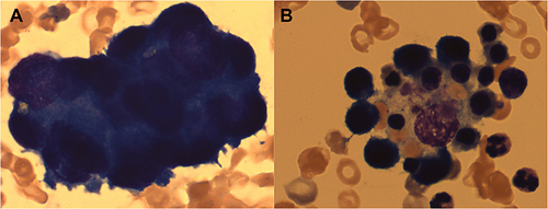 Figure 4 The bone marrow showed clustered abnormal cells (A) and haemophagocytes (B) (Wright-Giemsa staining, original magnification x 1000).