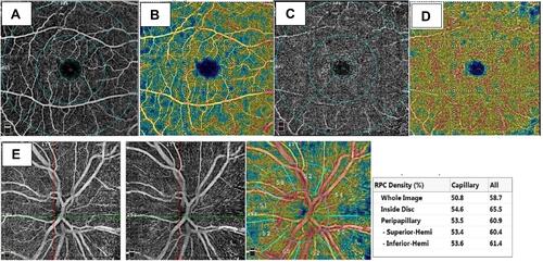 Figure 2 (A and B) Representative angiographic images of the right eye of case number 46 with AL±22.21mm (Group A), 6mm×6mm scan of the superficial plexus and density map, (C and D) of deep capillary plexus and its density map, (E) angiographic images of the optic disc 4.5×4.5mm scan.