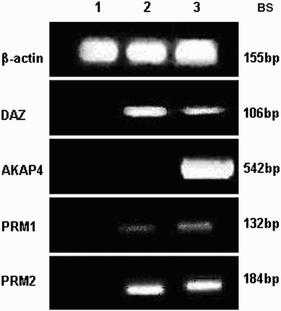 Figure 1.  RT-PCR results of DAZ, AKAP4, PRM1, and PRM2 genes in semen samples of NOA patients. The reference gene, β-actin, was used as the positive control. Lanes 1, 2, and 3: three NOA patients. BS: the band size for each gene.