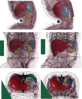 Figure 5. Differences of liver (red) and spleen (blue) shapes and positions for the M50 (left) and the F05 (right). In mid-abdomen impacts from Hardy et al. (Citation2001), the bar is below the M50 liver but engages the F05 liver (top, models scaled to the PMHS GI4). In the Kremer et al. (Citation2011) oblique impact, the impactor engages both livers (middle: models scaled to FBL08, bottom: baselines). The spleen is more posterior and more distant to the mid abdomen in the M50 than in the F05, which is likely to affect its engagement in mid-abdomen and side impact (top and bottom).