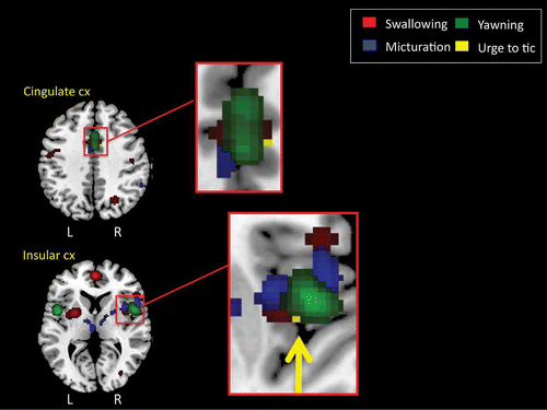 Figure 5. Regions of overlap between ALE meta-analytic studies of swallowing and micturition and fMRI studies of the urge to tic in individuals with TS (Bohlhalter et al., Citation2006) and the urge to yawn in neurologically normal adults. Again these analyses reveal regions of overlap within the insular cortex (CX) of the right hemisphere and the mid-cingulate cortex bilaterally.