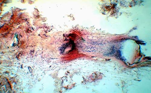 Figure 3 Histological assessment of poly(L-lactide-co-ε-caprolactone) showing that it is fully absorbed in a fibrous tissue collected after 18 months of treatment (H & E, original magnification 920).