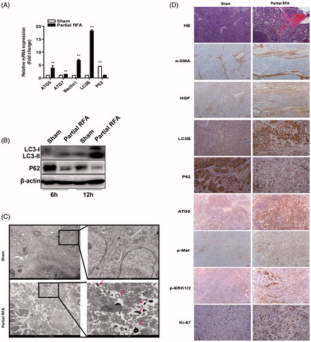 Figure 6. Incomplete RFA induced autophagy in residual HCC in an orthotopic HCC model. The mRNA expression (A) of ATG5, ATG7, Beclin1, LC3B, P62 and protein expression (B) of LC3B, P62 were assessed in residual HCC tissues after incomplete RFA. (C) AVs (red arrows) in the tissue sections of post-RFA residual HCC were detected by electron microscopy. (D) Immunohistochemical staining for LC3B, P62, ATG5, Ki-67, α-SMA, HGF, phosphorylated c-Met and phosphorylated ERK1/2 in residual HCC foci after incomplete RFA. Accumulation of activated HSCs (α-SMA, a marker of activated HSCs) surrounded the residual HCC foci. **, p < .01; *, p < .05, bar = 1 mm.