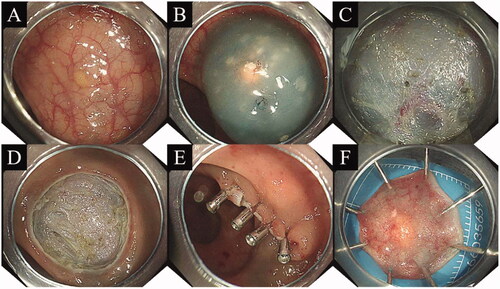 Figure 2. Procedure for endoscopic submucosal dissection. (A) Yellow hemispherical mass in the rectum; (B) Injection into the submucosal layer; (C) Entry into the submucosa for dissection; (D) Mucosal defect observed after endoscopic submucosal dissection; (E) Clip closure of mucosal defect; (F) The excised specimen was treated and analyzed in a standardized manner.