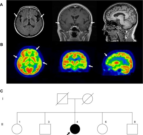 Figure 1 Brain structural neuroimaging data and family pedigree of the proband at diagnosis.