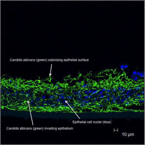Fig. 2.  Candida albicans biofilm formation on oral mucosal surfaces.Arrows indicate green fluorescing C. albicans (stained with a labelled peptide nucleic acid probe) infecting a reconstituted oral epithelium generated commercially from transformed human keratinocytes of the cell line TR146 (from a squamous cell carcinoma of the buccal mucosa; SkinEthic Laboratories, Nice, France); nuclei of epithelial keratinocytes are shown as blue (Hoescht staining).