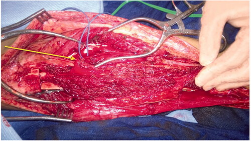 Figure 4. Intra-operative image of free microvascular fibular graft. Unconnected vascular structures can be seen in the free microvascular fibular graft (Arrow I). Beneath the transferred fibula, the hemi-tibia allograft plated with screws to the proximal portion of the tibia can be seen.