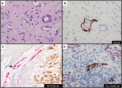 Figure 4 Detection and confirmation of lymphovascular invasion.