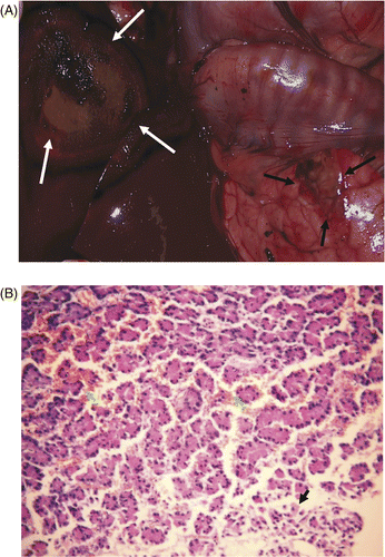 Figure 5. (A) Gross examination showed the colour of the pancreas (black arrow) abutting the ablated liver (white arrow) turned red in group B within one hour of microwave ablation. (B) Histological examination showed pancreatic cell degeneration (black arrow) and vessel haemorrhage (white arrow) in group B within one hour of microwave ablation (HE × 200).