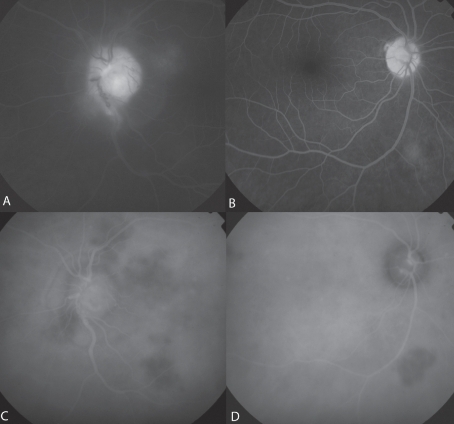 Figure 3 A, Late-phase fluorescein angiogram OS showing optic disc leakage secondary to uveitis. B, Late-phase fluorescein angiogram OD exhibits an hyperfluorescent area corresponding to the granuloma. C, Late-phase ICG angiogram OS reveals multiple choroidal hypofluorescent lesions of the posterior pole, optic disc leakage secondary to uveitis. D, Late-phase Indocyanine angiogram OD showing a single hypofluorescent area corresponding to the granuloma.