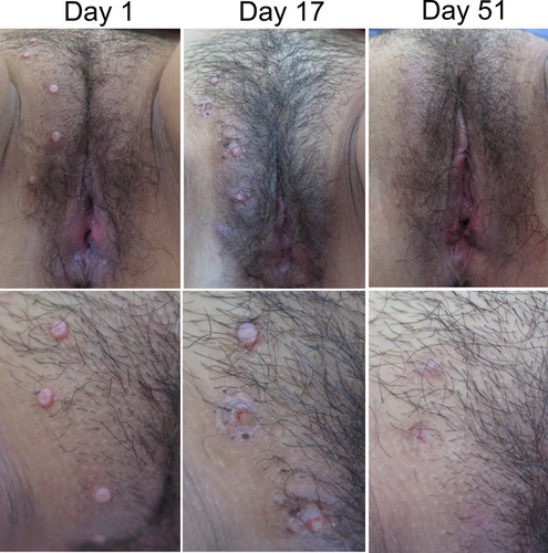 Figure 1 Clinical manifestation of molluscum contagiosum on genital area before and after 20% KOH treatment. All of the MC lesions disappeared and became post-inflammatory hyperpigmentation on day 51 of observation.