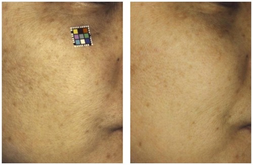 Figure 2 Before (left) and 6 months after (right) treatment of photodamaged skin with oral pine bark extract.