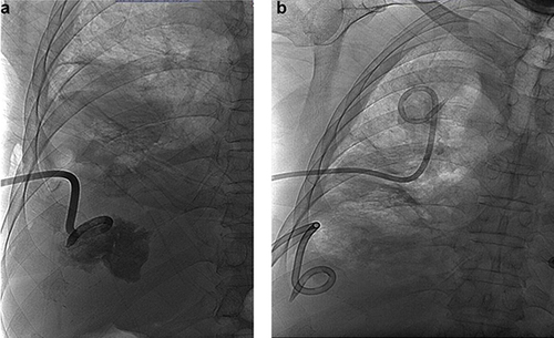 Figure 2 (a) Image of interventional therapy for pyopneumothorax on day 2 after admission. (b) Image of interventional therapy for pyopneumothorax on day 6 after admission.