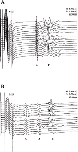 Fig. 1.  A wave pattern in the right tibial (panel A) and peroneal (panel B) nerves; compared to the F wave, the A waves have a constant latency and morphology.