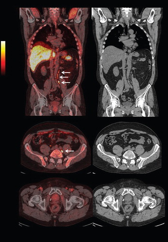 Figure 1. Positron emission tomography / computed tomography (PET / CT) diagnostic images (arrow ¬ showing FACBC-uptake in paraaortic lymph nodes).