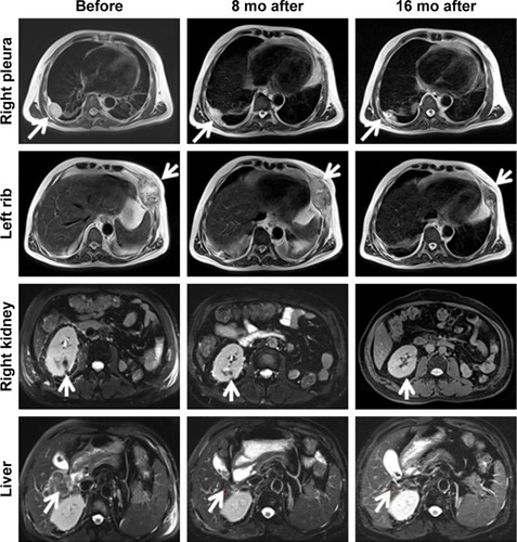 Figure 5 MR imaging findings at different time points before and after MBV treatment.Notes: For right pleural metastasis, the size was 5.4×4.4 cm (before), 3.9×3 cm (8 months after), and 1.6×1.4 cm (16 months after), respectively. For left rib metastasis, the size was 7.3×6.3 cm (before), 4.8×3 cm (8 months after), and 1.9×1.1 cm (16 months after), respectively. For right kidney metastasis, the size was 3.8×3.6 cm (before), 2.9×2.2 cm (8 months after), and 2.1×1.5 cm (16 months after), respectively. For liver metastasis, the size was 5.2×4.3 cm (before), 3.6×3.2 cm (8 mo after), and 1.9×1.8 cm (16 months after), respectively. White arrows indicate the tonsil mass.Abbreviations: MBV, mixed bacterial vaccine; MR, magnetic resonance; mo, months.