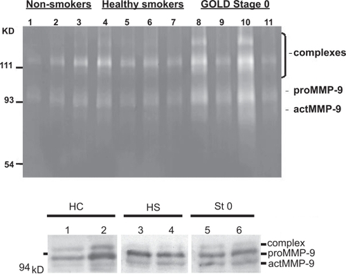 Figure 4 Zymography and Western blotting analysis of MMP-9 in the sputum specimens. Representative zymography of 11 specimens (A): Gelatinolytic activity at 92 kD (pro-MMP-9) and 77–82 kD (activated MMP-9) of non-smoking controls (lanes 1–3), cigarette smokers (lanes 4–7), and subjects at GOLD stage 0 (lanes 8–11). Individual variation occurred, but generally MMP-9 was activated in smokers and especially those at GOLD Stage 0. Representative Western blotting of 6 specimens (B): HC healthy non-smoking control (lanes 1–2), HS healthy smoker (lanes 3–4), St 0 Stage 0 (lanes 5–6). There was individual variation, when calculated from 16 specimens no significant differences between the groups could be seen. Molecular weight standards at the left.