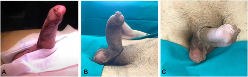 Figure 3 Postoperative pictures documenting valid penile erections. Highly satisfactory results were documented at the end of the surgical procedure (A) and at the 2-year follow-up (B and C). A maximally turgid state was achieved by inflating the three-piece IPP using the scrotal pump placed in the right subdartos pouch.
