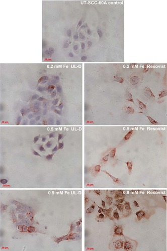 Figure 9 Cellular uptake of UL-D and Resovist®-labeled tumor cells.Notes: UT-SCC-60A cells were incubated with 0.2 mM, 0.5 mM, and 0.9 mM Fe UL-D and Resovist® for 24 hours, stained with anti-dextran, and analyzed by microscopy. Nuclei staining by H&E. The manufacturer of Resovist® is Bayer Schering Pharma AG, Leverkusen, Germany.Abbreviations: H&E, hematoxylin and eosin; UL-D, University of Luebeck-Dextran coated superparamagnetic nanoparticles.