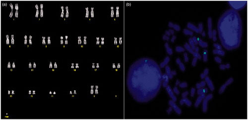 Figure 1. Conventional and FISH cytogenetic findings. (a) A QFQ banded metaphase spread showing the supernumerary small marker chromosome (indicated). (b) FISH on metaphase spread using CEP 10 probe (white [green]), showing the both chromosomes 10, and the smaller sSMC. FISH: fluorescence in situ hybridization.