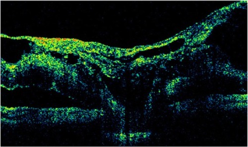 Figure 37 Stratus optical coherence tomography image.