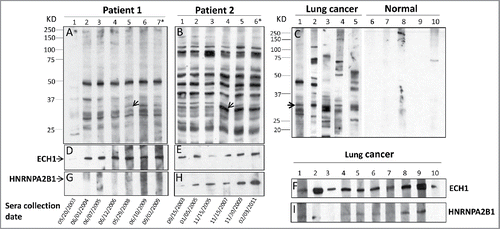 Figure 1. Western blotting analysis. (1A and 1B): Reactivity of serial serum samples from two representative LC patients in group 1 to LC cell line H1299. Patient 1 was a 69-y-old Caucasian male who was a current heavy smoker (more than 50 pack years) and started to smoke at the age of 16-y-old. He was drawn sequential serum samples between year of 2003 and 2011 and diagnosed as lung adenocarcinoma of stage IA in Oct. 2009. As shown in 1A, in the initial serum sample collected in May 2003, autoantibodies were barely observed, but appeared one year later, 5 y before the diagnosis of LC. The 34 kD band (arrow) arose at the time point of 1.5 y before the lung cancer diagnosis (lane 5 in 1A) and reached at the highest titer at the time of 3 mo before the diagnosis (lane 6 in 1A). Fig. 1(B) Shows a 64-y-old Hispanic male, who has been smoking for 44 y with average 32 pack years, since he was 20 y old and diagnosed as small cell LC in stage IA when he was 64-y-old. A 34 kD reactive band (arrow) was observed in the initial serum sample collected in Sept. 2003 (lane 1 in 1B), but the titer was sharply increased 4 y later that was the time point of 3 y (lane 4 in 1B) before LC diagnosis. (1C) Reactivity of serum samples from five lung cancer patients in group 1, which drawn at the diagnosis of LC and five normal individuals in group 2 to H1299 cell line. 1D-1I: Immunoreaction of recombination protein ECH1 (1D–1F) and HNRNPA2B1 (1G–1I) to the serial serum samples from two representative patients the same with 1A and 1B, and to 10 representative individual sera (1F and 1I) from LC patients in group 3. *Time of lung cancer diagnosis (patient 1 was diagnosed in Oct. 2009 and patient 2 in April 2001).