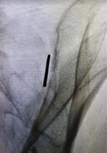 Figure 1 Optimal placement of guide pin in the oblique view.