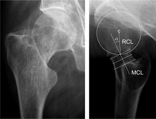 Figure 2 AP (left) and lateral (right) radiographs of a Garden II femoral neck fracture demonstrating posterior tilt (a) measured as the angle between the mid-column (neck) line (MCL) and the radius column (neck) line (RCL), drawn from the center of the femoral head (C) to the point at which the femoral head and MCL cross.