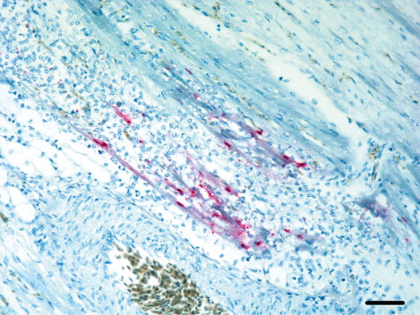 Figure 8. Micrograph of the heart from a meat-type duck showing viral antigens detected in the myofibres of necrotic lesion. Biotin–streptavidin complex with haematoxylin counterstain. Scale bar: 50 µm.