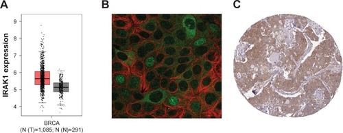 Figure 1 IRAK1 expression in The Cancer Genome Atlas (TCGA) database and The Human Protein Altas.Notes: (A) IRAK1 was highly expressed in breast cancer tissues compared with normal breast tissues based on TCGA database. (B) IRAK1 expressed in MCF-7 cell line. (C) IRAK1 expressed in breast cancer tissue.