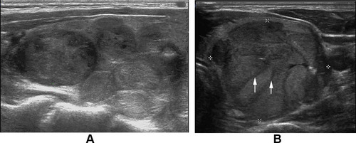 Figure 5 (A) Follicular thyroid carcinoma of the left thyroid in a 58-year-old female. Longitudinal sonogram indicates the cluster of grapes sign. (B) Follicular thyroid carcinoma of the left thyroid in a 27-year-old male. Transverse sonogram shows obvious cluster of grapes sign and the thick and hypoechoic fibrous band (arrow).