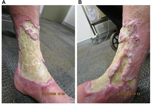 Figure 3 Excessive fibrin and thickening of the ulcer floor at week 18 of tildrakizumab treatment on the (A) medial and (B) anterolateral aspects of the left leg.