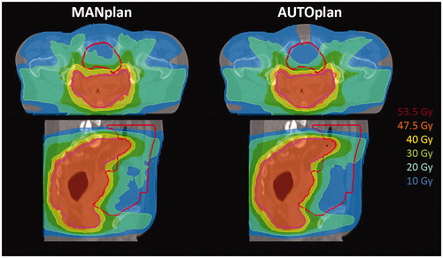 Figure 2. Dose distributions for the MANplan (left) and AUTOplan (right) for patient 14 (See Figure 1). The AUTOplan had clearly reduced dose in the OAR. Top: axial view, bottom sagittal view. Magenta contour = PTV, Red contour = OAR.