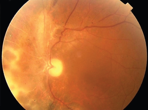 Figure 2 Regression of retinitis following treatment with ganciclovir, leaving retinal pigment epithelial changes and pale optic disc.