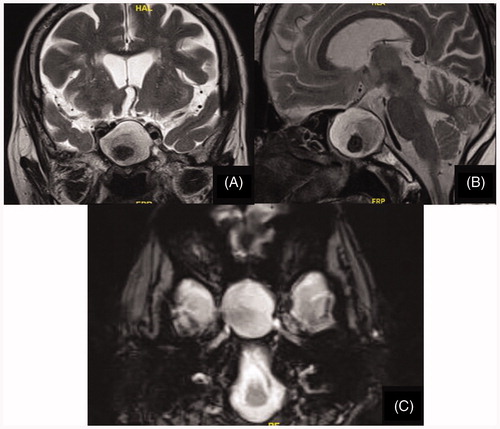 Figure 2. MRI of the nose and paranasal sinuses (A, coronal view; B, sagittal view and C, axial view) showing an expansile cystic lesion in the sphenoid sinus with hypointense debris within, consistent with sphenoid sinus mucocele. Infundibulum of pituitary and optic chiasma are pushed superiorly.