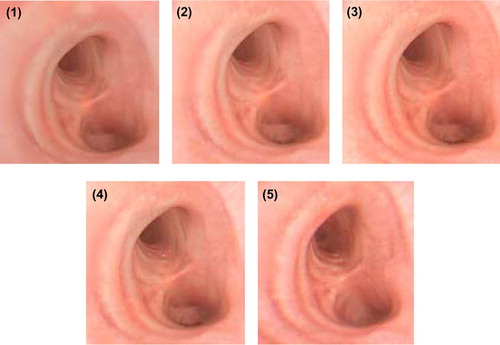 Figure 5. Example images showing the five different categories used for user evaluation. (1) Unreal; (2) BRDF-low resolution; (3) BRDF; (4) BRDF-Specular; and (5) Real bronchoscope image. [Color version available online.]