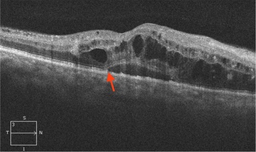 Figure 7 Diabetic macular edema showing disruption of both photoreceptor ISel band and ELM (red arrow), large cystic spaces, and serous detachment.