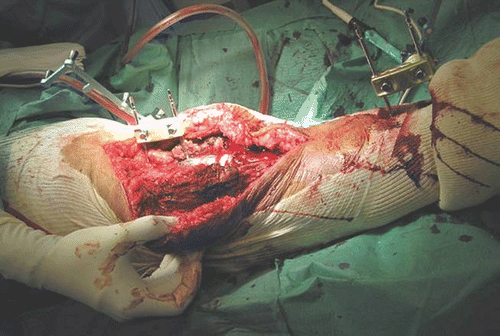 Figure 3. Operative view showing the placement of the beacons on the tibia and femur. [Color version available online.]