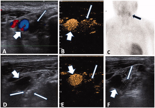 Figure 1. Microwave ablation of ectopic secondary hyperparathyroidism nodule in the mandibular area. (A) Hypoechogenic nodule (thin arrow) without blood signal beside the carotid artery (thick arrow) in pre-ablation CDFI ultrasound scan in the 53-year-old male patient. (B) A uniform hyper-enhanced nodule (thin arrow) beside the carotid artery (thick arrow) was displayed in contrast-enhanced ultrasound pre-ablation. (C) Nodule with radioactivity (black arrow) in late phase of MIBI scan. (D) Hyperechoic region inside nodule (thin arrow) beside the carotid artery (thick arrow) during ablation. (E) A non-enhanced area covered the nodule (thin arrow) beside the carotid artery (thick arrow), which suggested complete ablation. (F) Small and iso-echogenic SHPT nodule (thin arrow) beside the carotid artery (thick arrow) was displayed in ultrasound one day after ablation.