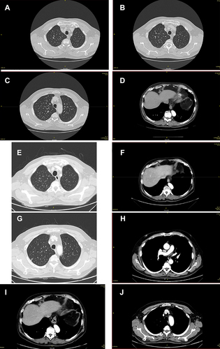 Figure 12 (A–D and G–J) CT scan of bone, lymph node, lung; (E and F) follow-up CT scan lung and lymph node.