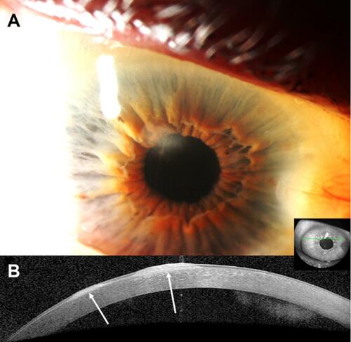 Figure 2 Clinical and anterior segment optical coherence tomography (OCT) images of a 65-year-old male with a history of wet age-related macular degeneration in the right eye who was referred for evaluation of corneal scars. Clinical examination revealed two superior Salzmann lesions in the right eye, which were treated conservatively with ocular surface lubrication. The nodules remained stable for 6 years since initial presentation. (A) Slit-lamp photograph of the right eye demonstrating a white, round-shaped, paracentral corneal opacity between eleven and twelve-o’clock. (B) Heidelberg Spectralis high-resolution OCT demonstrates two distinct hyper-reflective, subepithelial nodules (arrows) with thinned overlying epithelium. In this case, a clear distinction is noted between the nodules and underlying Bowman’s layer.