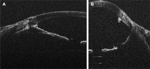 Figure 2 Intraoperative OCT showing (A) peripheral anterior synechiae posterior to the opacification and (B) after surgery, deepening of the anterior chamber and lysis of adhesion.