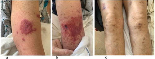 Figure 1. Violaceous skin rashes on.