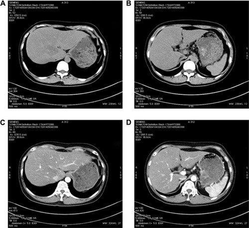 Figure 3 Post-therapy abdominal CT of the patient with hepatic metastasis in May 2014.
