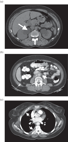 Figure 1. CT scan on admission showed (a) severe bilateral hydronephrosis and ureteral obstruction caused by a retroperitoneal mass at the level of L4; (b) a retroperitoneal mass that appeared as fibrosis; and (c) prominent right pleural fibrosis.