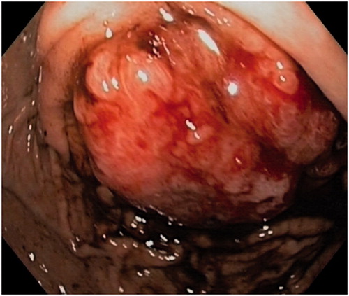 Figure 1. Pt #1: Male 48 years of age. Endoscopic view of the gastric tumour located in the fundus.