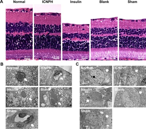 Figure 2 HE staining and TEM observation of the retinal microstructure and ultrastructure changes in rats at 2 weeks after subconjunctival injection.Notes: (A) The representative images of HE staining in retina in different groups. (B) The changes of retinal microvascular structure in different groups. (C) The changes of retinal ganglion cells structure in different groups. Retinal microvascular or retinal ganglion cells are identified by arrows. Normal group: no injection with any drugs; ICNPH group: subconjunctival injection of 20 µL ICNPH containing 80 µg insulin; Insulin group: subconjunctival injection of 80 µg insulin in 20 µL deionized water; Blank group: subconjunctival injection of 20 µL blank nanosized hydrogel; Sham group: an empty syringe without any drugs was punctured into the conjunctiva of the diabetic rats.Abbreviations: ICNPH, insulin-loaded chitosan nanoparticles/PLGA-PEG-PLGA composite hydrogel; PLGA-PEG-PLGA, poly(lactic-co-glycolic acid)-poly(ethylene glycol)-poly(lactic-co-glycolic acid); TEM, transmission electron microscope.