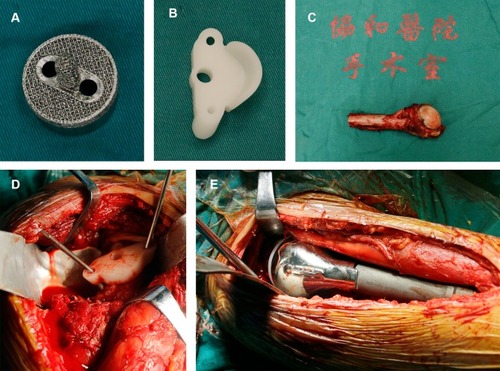 Figure 3 (A) A personalized 3D-printed glenoid prosthesis; (B) a 3D-printed guiding baseplate; (C) en bloc resection specimen of the tumour; (D) the 3D-printed guiding baseplate was placed in the appropriate location (the middle and lower third of the glenoid) and fixed with two Kirschner wires; (E) the custom-made humerus prosthesis was implanted and fixed with cement.Abbreviation: 3D, three-dimensional.