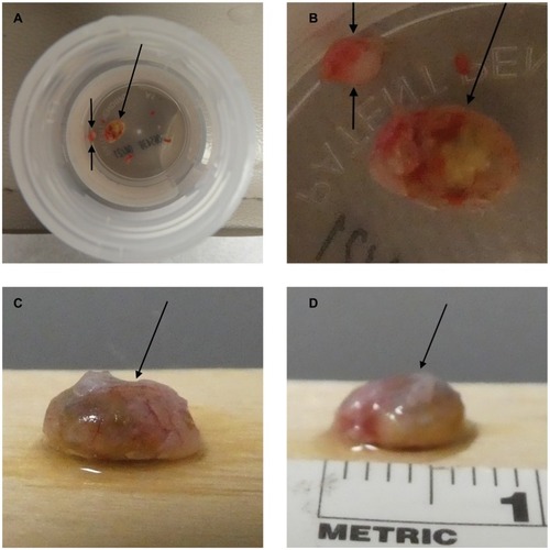 Figure 2 Gross presentation of osteoma cutis.