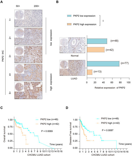 Figure 2 High expression of PKP2 predicts poor prognosis in LUAD patients. (A) LUAD tissue microarray (TMA) was prepared and IHC staining of PKP2 was performed. The representative staining of PKP2 was shown and the expression of PKP2 was scored as 1–5+ based on the IHC staining intensity. (B) The distribution of PKP2 IHC staining scores in LUAD tissues and adjacent normal tissues was analyzed. (C) Kaplan-Meier analysis was performed to analyze the overall survival (OS) in LUAD patients with low or high-expression of PKP2. (D) Kaplan–Meier analysis was performed to analyze the disease-free survival (DFS) in LUAD patients with low or high-expression of PKP2. **P < 0.01.